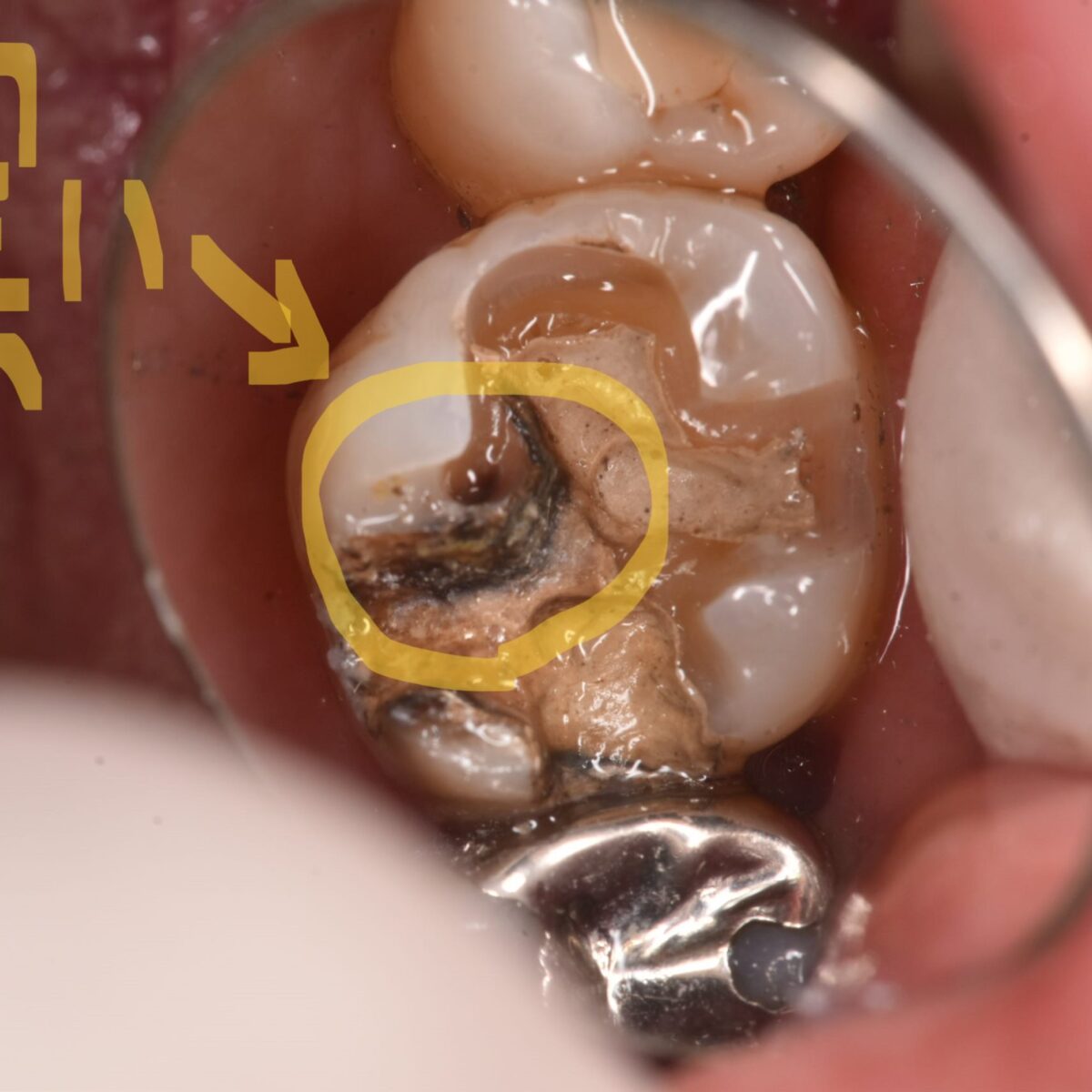 治療した歯はずっと安全なのか？銀歯は何がいけないのか？