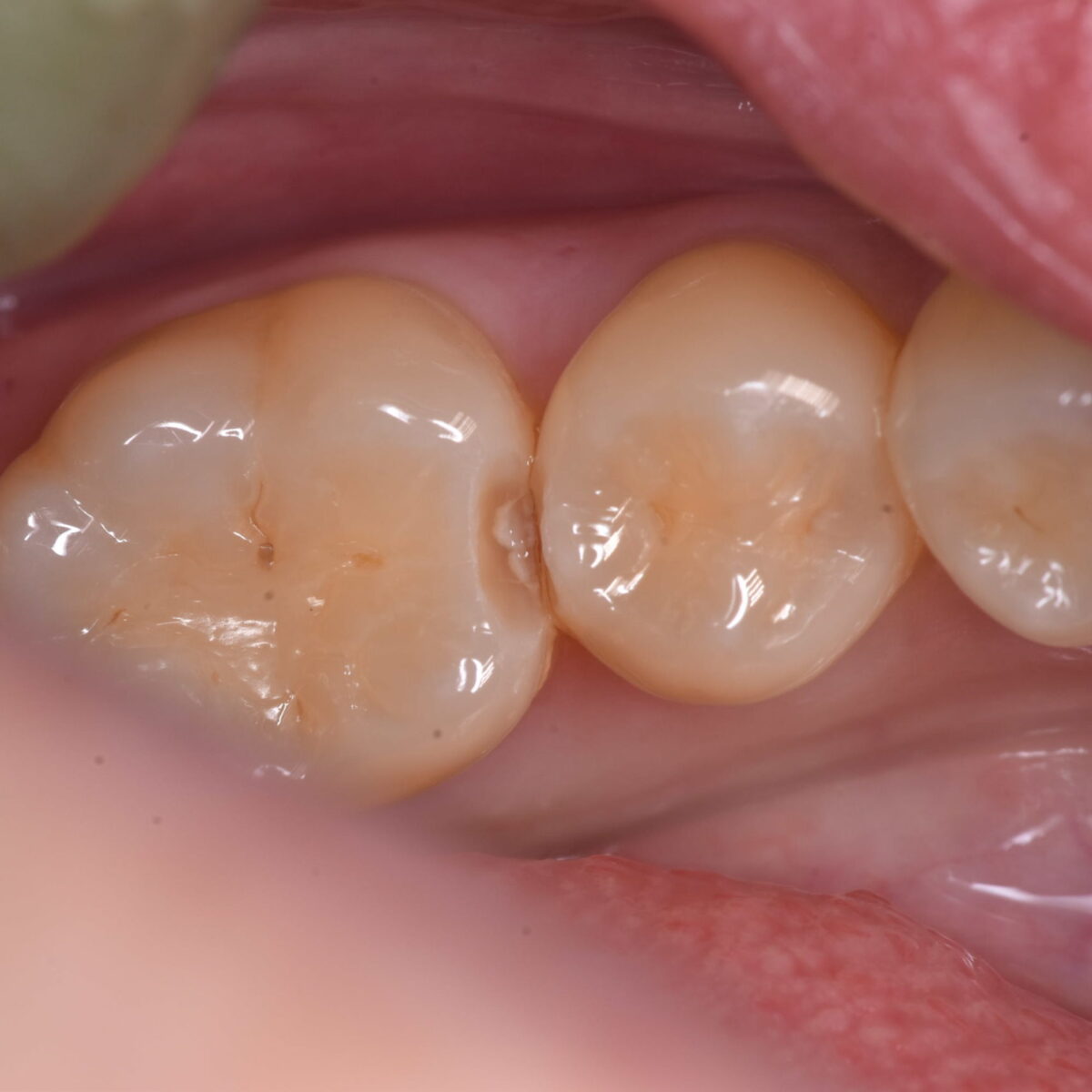 治療したことのない、白い歯だからと言って問題がないわけではない