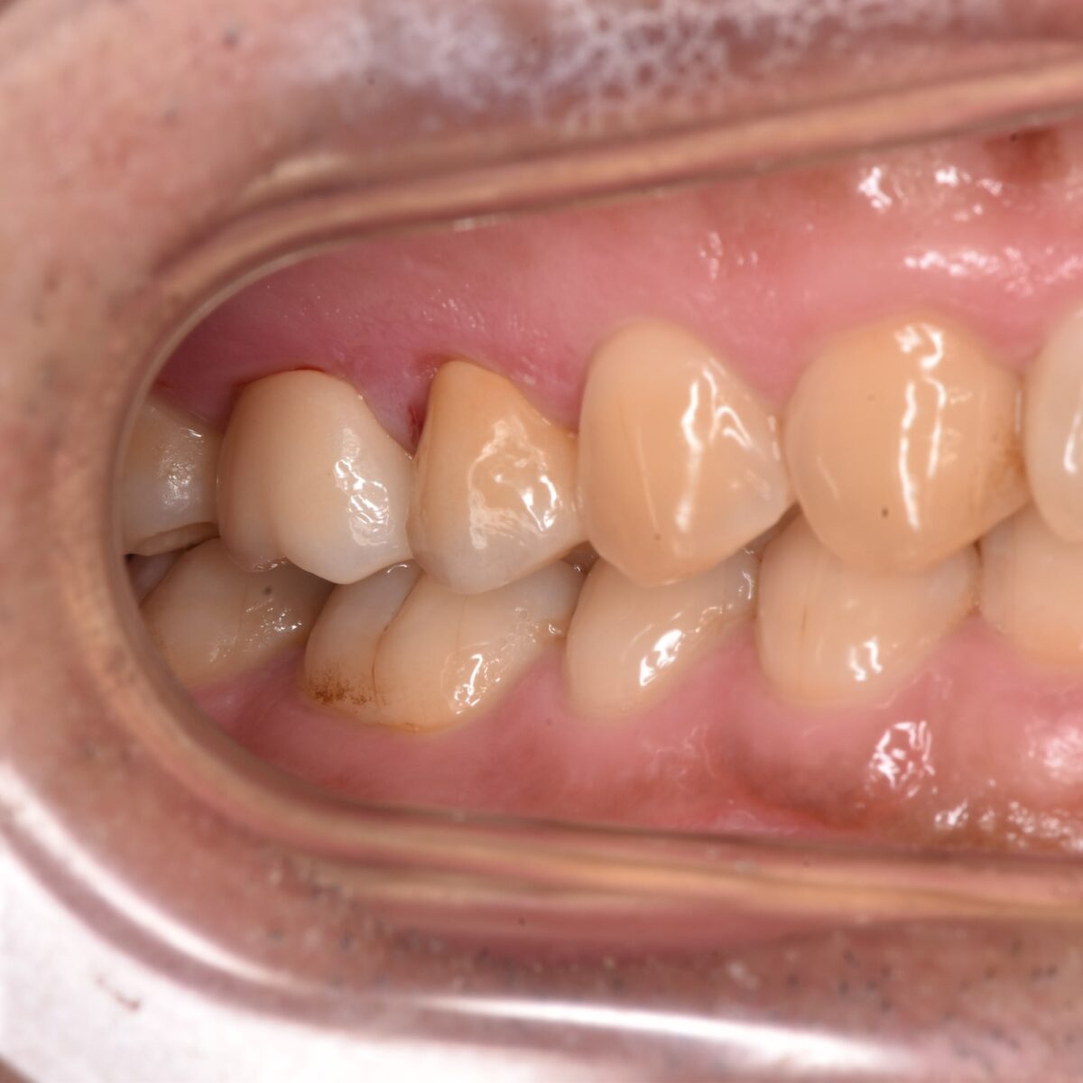 奥に隠れた大きな虫歯をとって、セラミックを被せた治療