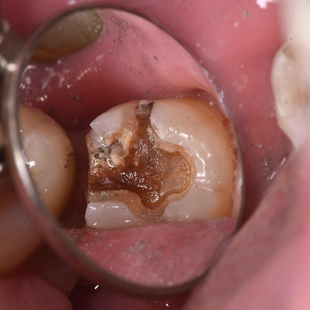 どういうクオリティで口の中の治療をするのか？で、その後の口の状態は変わってくる