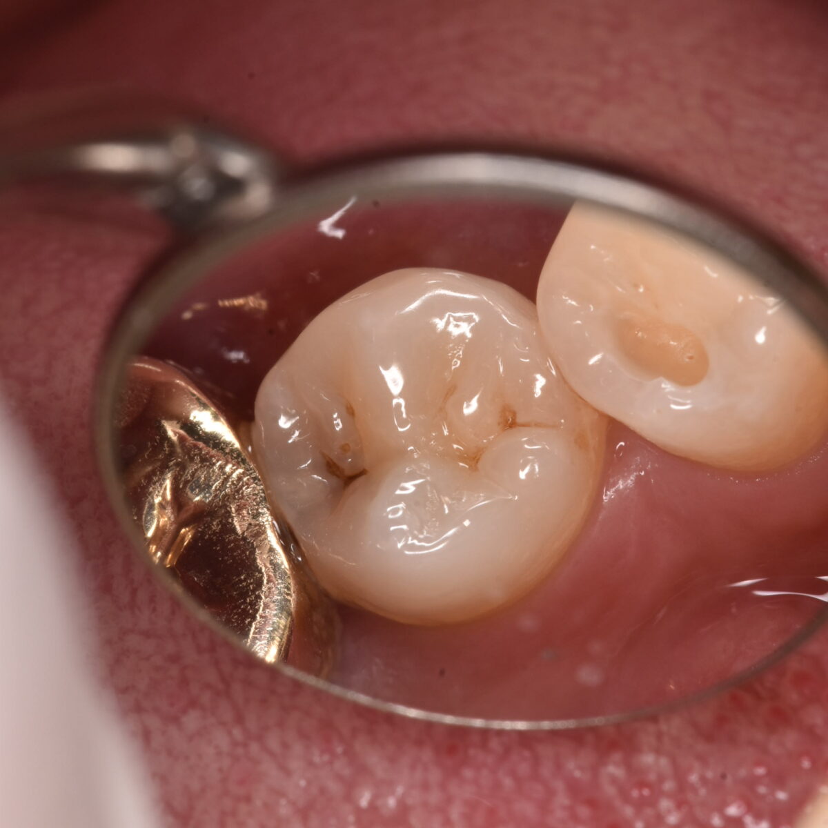 外から虫歯の大きさはわかるのか？