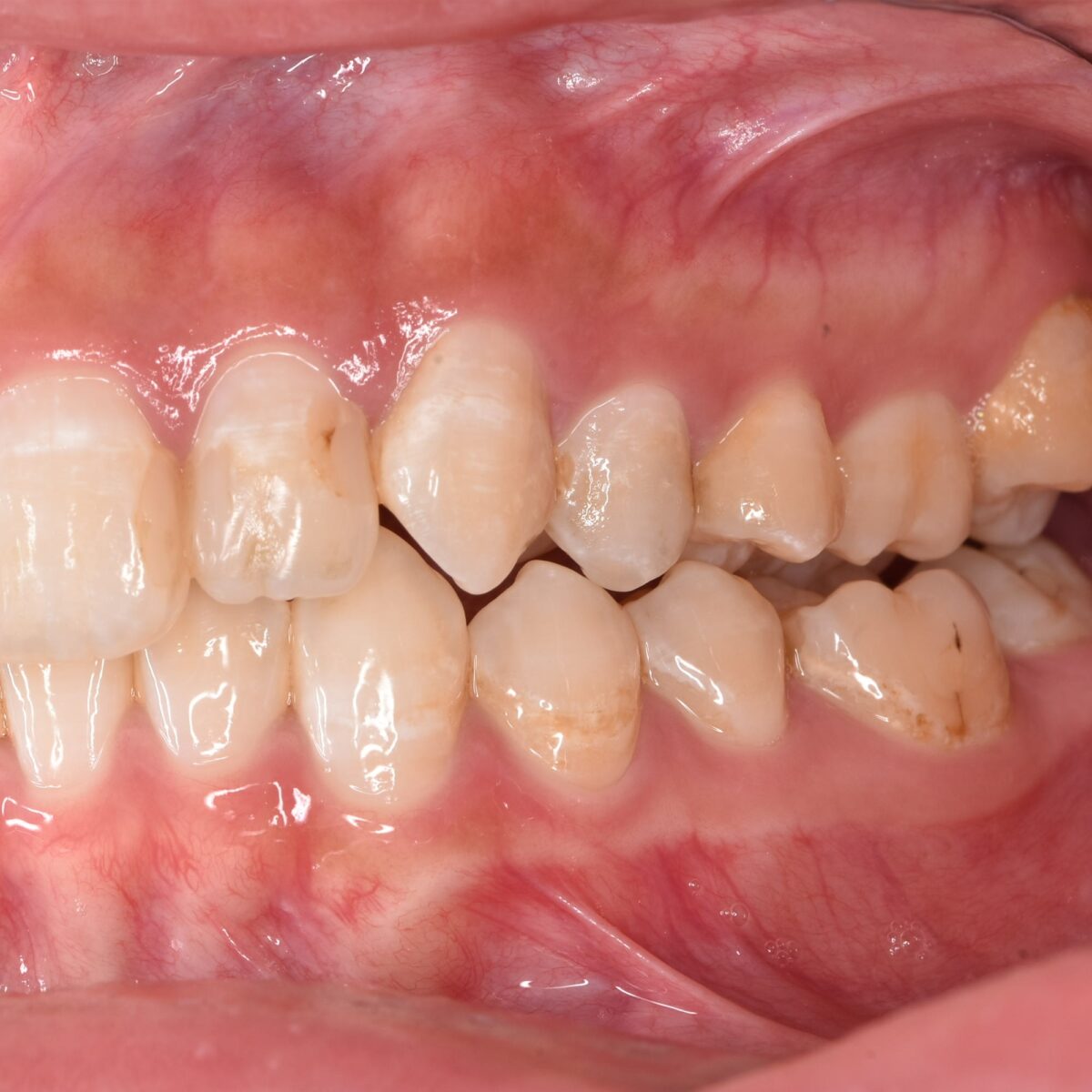 矯正って、とりあえずやればよくなるものなの？