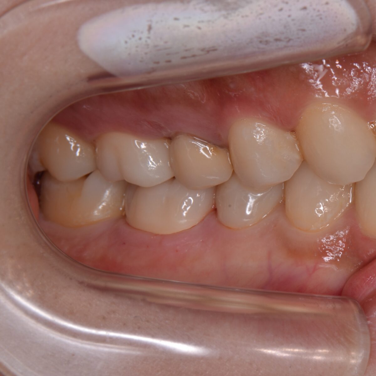 右下第一大臼歯のむし歯をとって、セラミックスクラウンを装着したケース