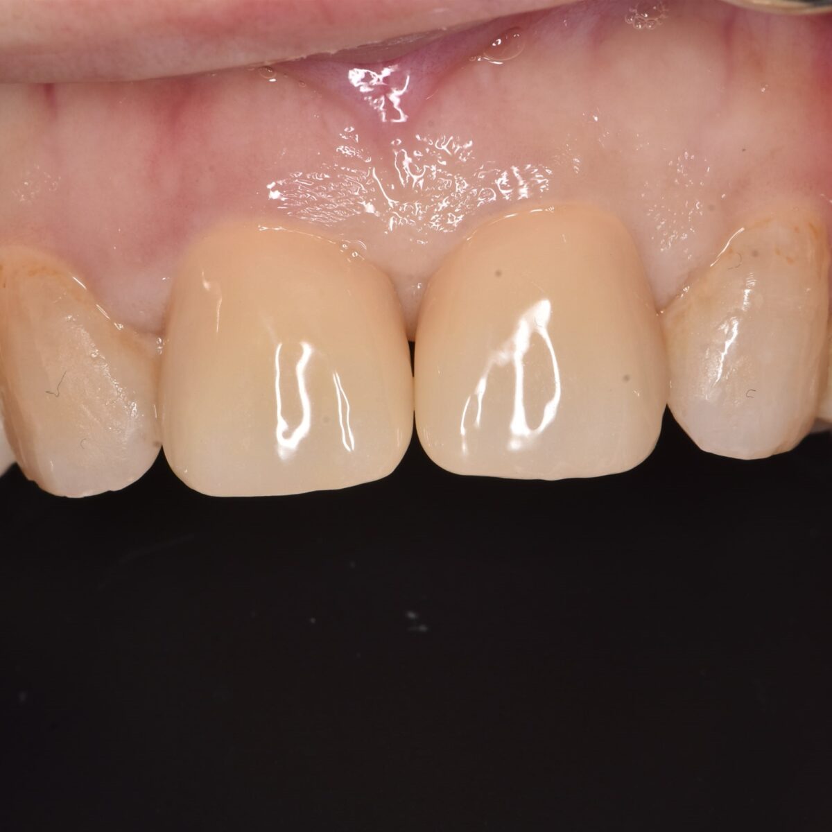 上の不揃いな前歯をセラミックスクラウンできれいに並べたケース