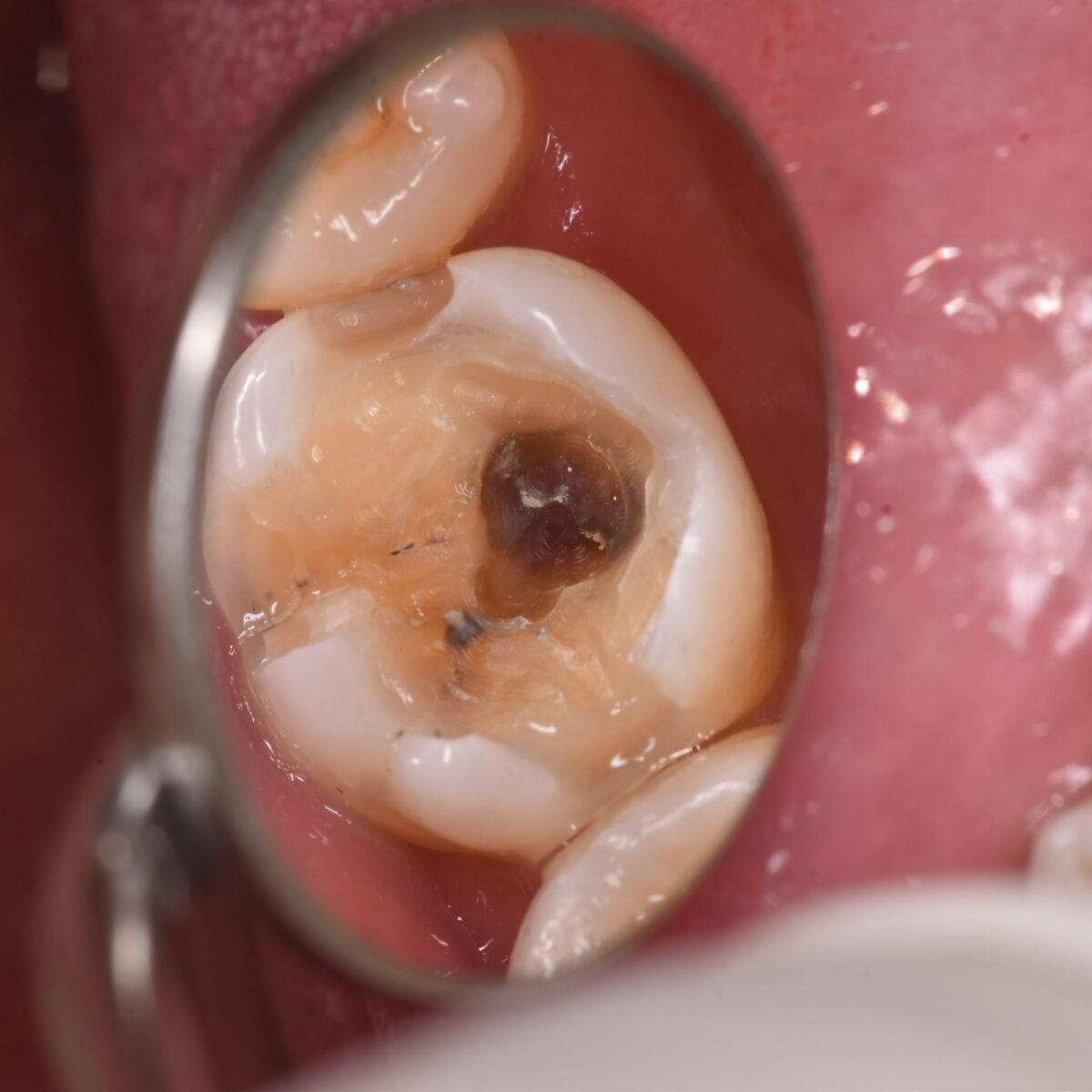 右下奥歯の銀歯を外したら、中にカリエスが見つかったケース
