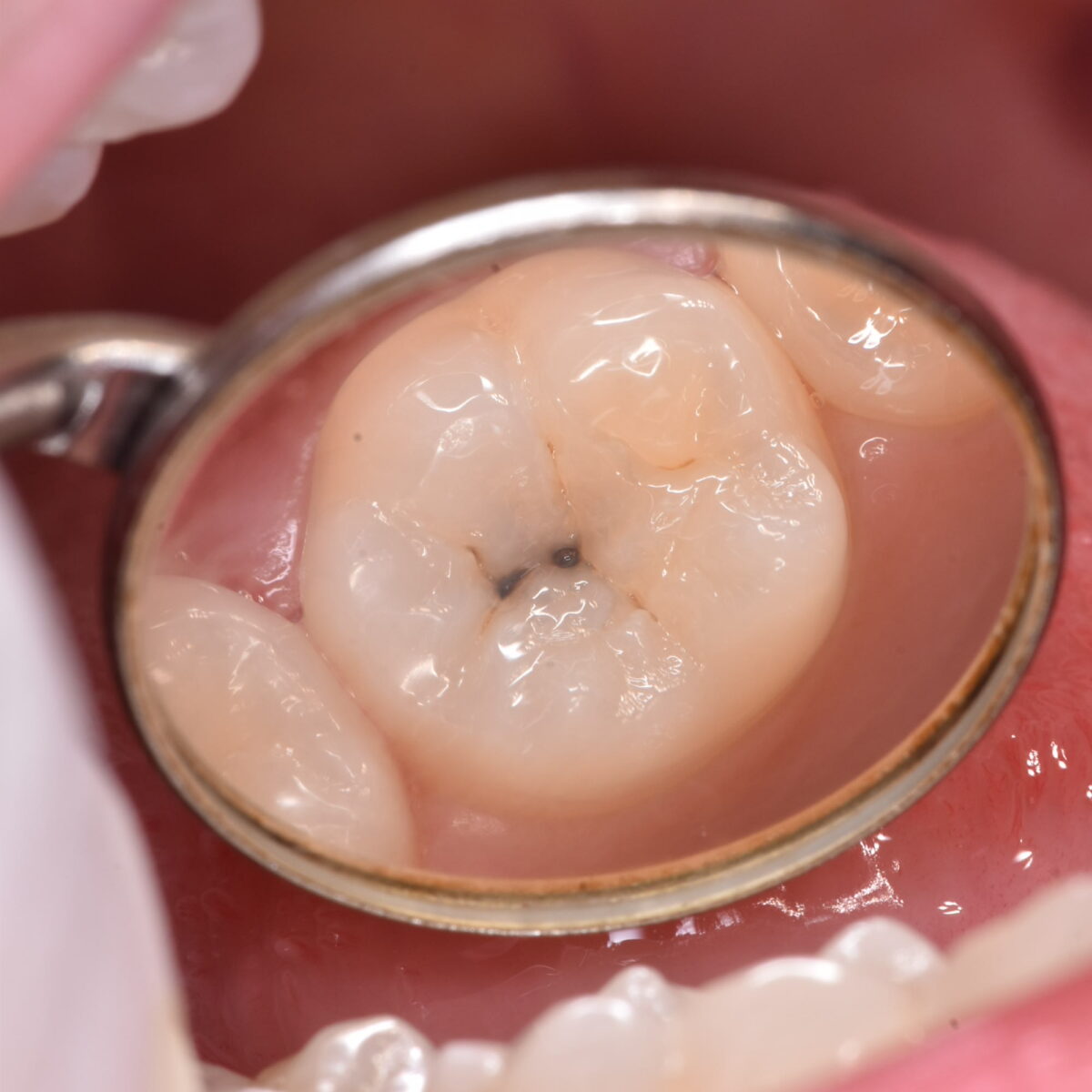 外側から一目でむし歯の大きさがわかるわけではないことを教えてくれるケース