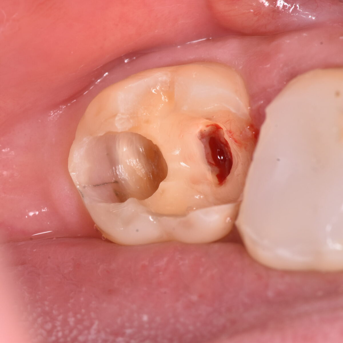 治療した歯の中でむし歯が広がり、神経まで到達していたケース