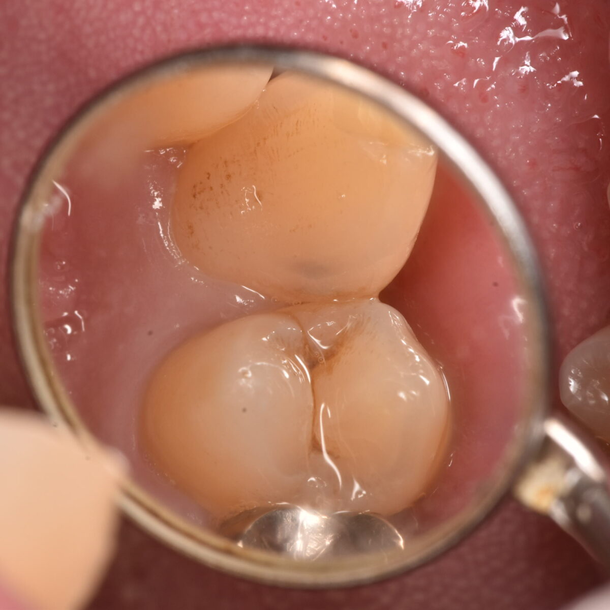 見た目には問題なく見えても、内部でむし歯が進行していたケース