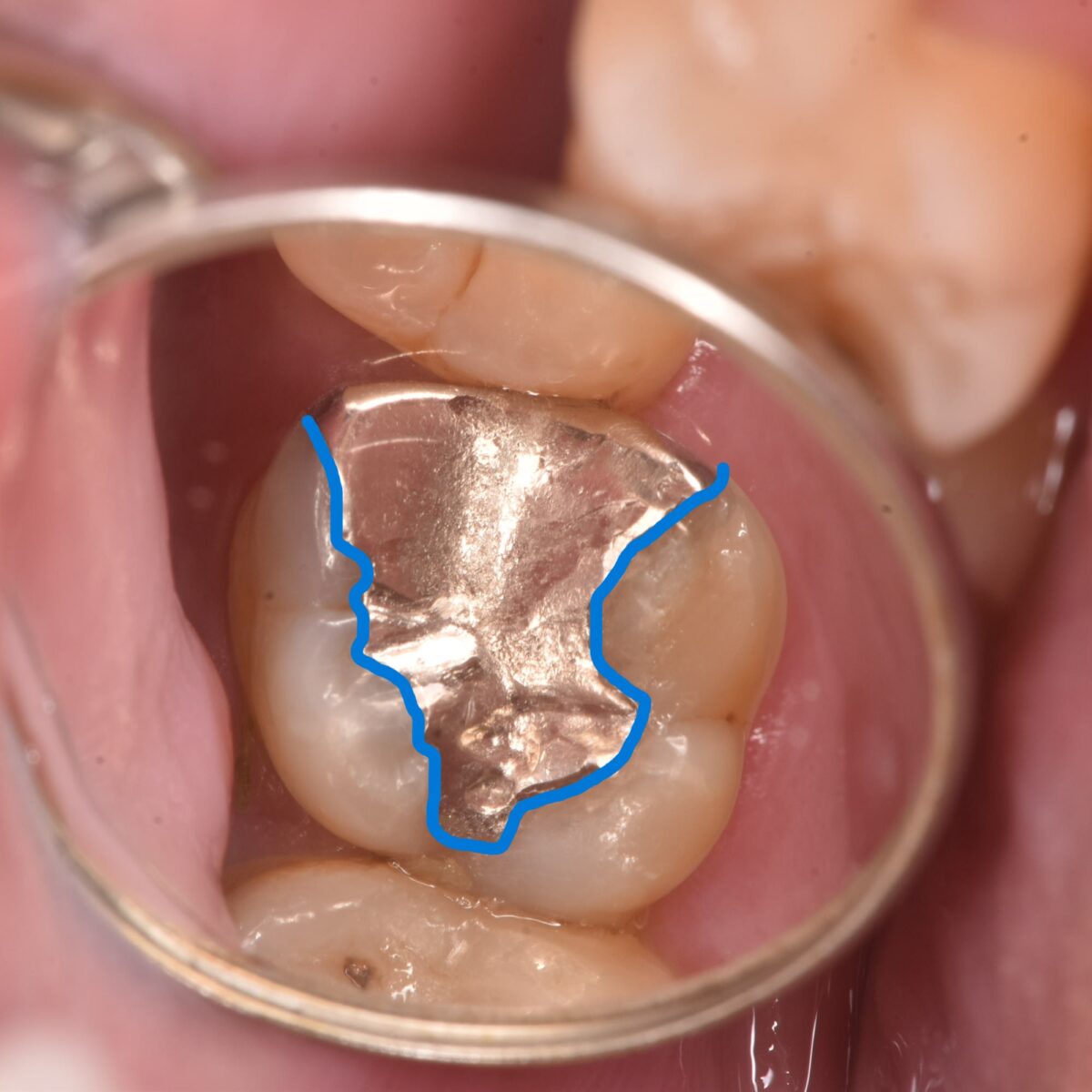時間の経った銀歯の治療