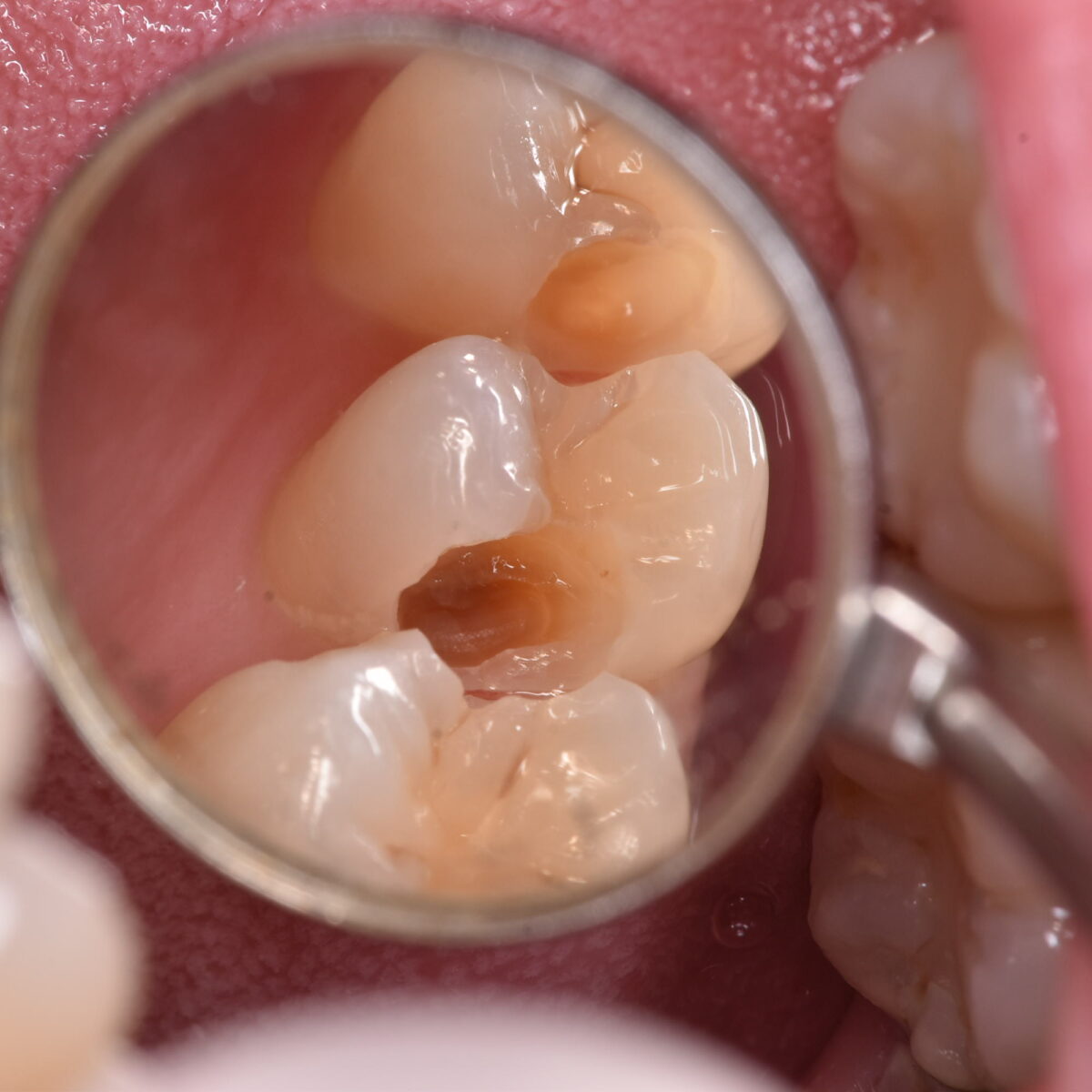 歯と歯の間がおかしくなくても、むし歯が隠れていることはよくある